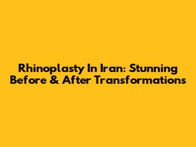 Rhinoplasty In Iran: Stunning Before & After Transformations